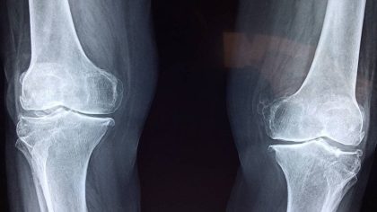 Cancer des os : les signes précoces à ne pas ignorer
